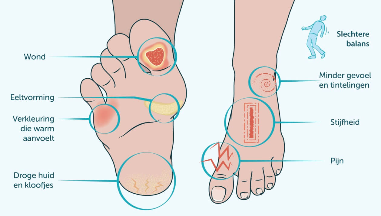 Diabetes voet- Jose Lauwers